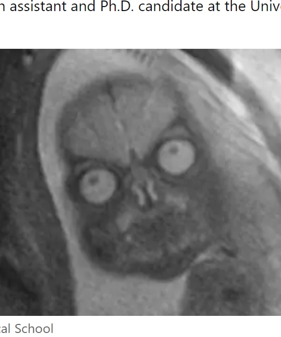 こんな赤ちゃんの写真を見せられたら、恐怖に震えてしまう？　ケイティさんが「お腹に宿る悪夢のような悪魔」と表現する恐ろしい表情の赤ちゃん（画像は『LADbible　2023年5月16日付「People are horrified after seeing MRI images of a baby inside the womb」（Featured Image Credit: Harvard Medical School）』のスクリーンショット）