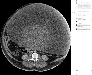CTスキャンが捉えた巨大な嚢胞。大きなものは46センチx45センチx33センチもあり、今年4月に7時間の手術で摘出された（画像は『if_you_incyst　2023年5月1日付Instagram「I applied for my records from the hospital.」』のスクリーンショット）