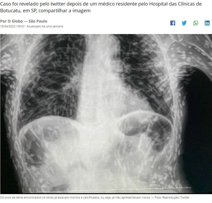 「嚢虫症」に感染した患者。慢性的な咳が2か月続いたためにレントゲン撮影を行ったところ、胸郭や腕全体に無数の白い点が浮かび上がった。白い点は嚢虫がすでに死んで石灰化したもの（画像は『O GLOBO　2023年4月19日付「Raio X de paciente cheio de ovos de tênia pelo corpo viraliza; entenda o que é a cisticercose」（Foto:Reprodução/ Twitter）』のスクリーンショット）