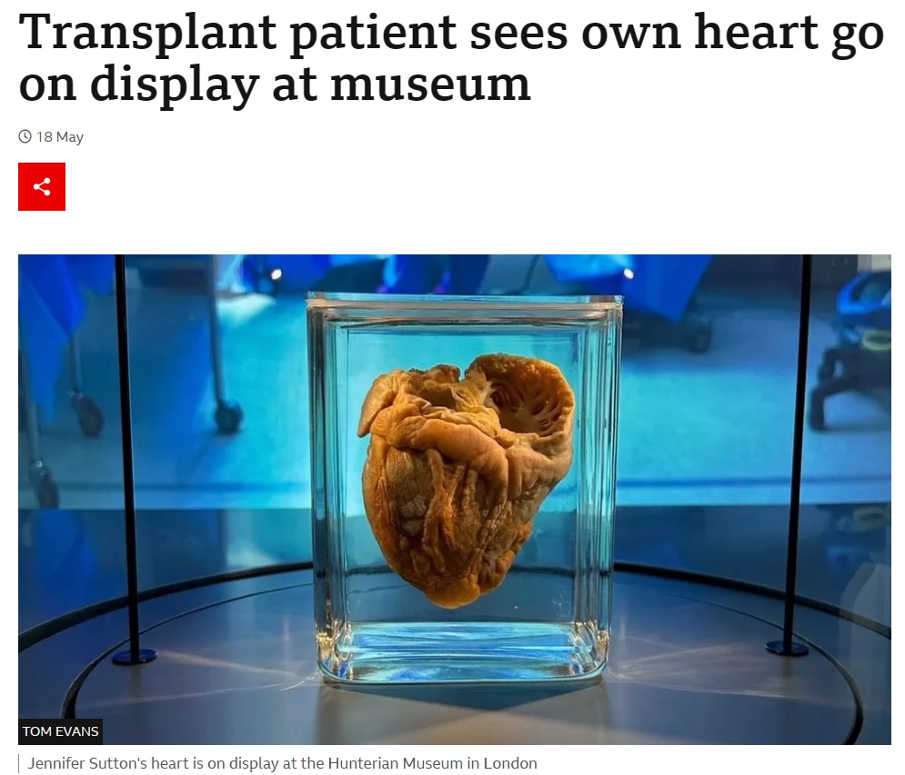 心臓の移植手術が成功し、その時に摘出されたジェニファーさんの心臓はロンドンの「ハンテリアン博物館」に展示されることになった（画像は『BBC　2023年5月18日付「Transplant patient sees own heart go on display at museum」（TOM EVANS）』のスクリーンショット）