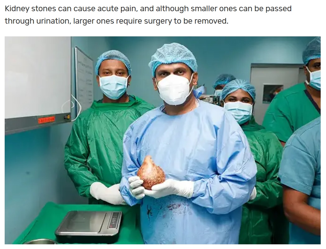 腎臓を切開し、大きな腎臓結石を摘出した医師たち。男性の腎臓は結石を抱えていながらも正常に機能しており、前立腺の肥大以外にほとんど影響は無かった（画像は『Guinness World Records　2023年6月15日付「World’s largest and heaviest kidney stone removed from Sri Lankan man」』のスクリーンショット）