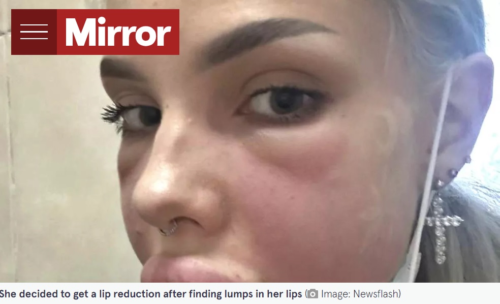 リップフィラーでボリューミーな唇をキープしてきた21歳の女性。唇に異常を感じ、リップフィラー溶解剤を封入したところアレルギー反応を起こした（画像は『The Mirror　2023年6月26日付「‘I nearly died having lip filler removed - they were bursting after allergic reaction’」（Image: Newsflash）』のスクリーンショット）