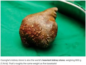 摘出された腎臓結石は玉ねぎのような形をしており、重さ800グラムで世界最重量の腎臓結石としてもギネス世界記録を更新した（画像は『Guinness World Records　2023年6月15日付「World’s largest and heaviest kidney stone removed from Sri Lankan man」』のスクリーンショット）