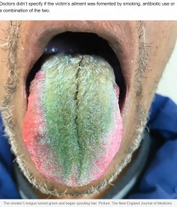 表面の突起である舌乳頭（糸状乳頭）が長く伸び、毛が生えたような状態の64歳の男性の舌。緑色に変色しており明らかに異常だが、痛みなどはないという（画像は『news.com.au　2023年7月12日付「Smoker’s tongue turns green, spouts hair after rare reaction」（Picture: The New England Journal of Medicine）』のスクリーンショット）