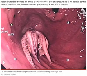胃カメラで確認すると、足が付いたままのタコが食道に詰まっていた。男性はほとんど噛まずにタコを飲み込んでしまったようだ（画像は『New York Post　2023年7月5日付「Doctors flabbergasted after finding octopus in patient’s throat」（Jam Press/AGA Institute）』のスクリーンショット）
