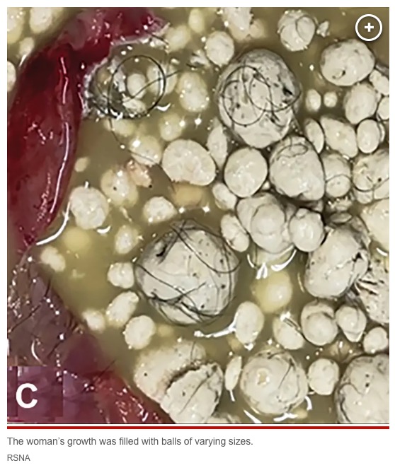 嚢腫の中には毛髪や脂肪の塊、大小様々なケラチンの塊が無数に入っていた。嚢腫の摘出後、女性は合併症なども無く、6か月経っても再発せずに無事に完治したと見られる（画像は『New York Post　2023年7月26日付「Woman has ‘sack of marbles’ growing on scalp since childhood removed」（IMAGE: RSNA）』のスクリーンショット）