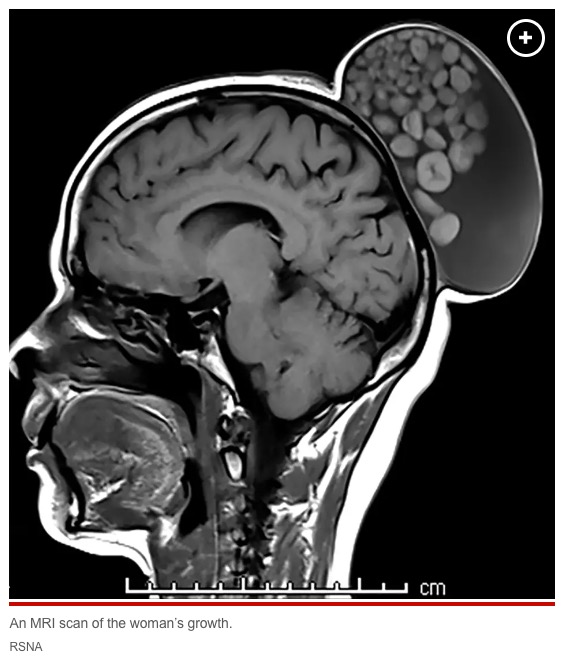 後頭部の上の方にまるで“お団子ヘア”のような大きな嚢腫。この嚢腫の中には毛髪や脂肪の塊、大小様々なケラチンの塊が無数に入っていた（画像は『New York Post　2023年7月26日付「Woman has ‘sack of marbles’ growing on scalp since childhood removed」（IMAGE: RSNA）』のスクリーンショット）