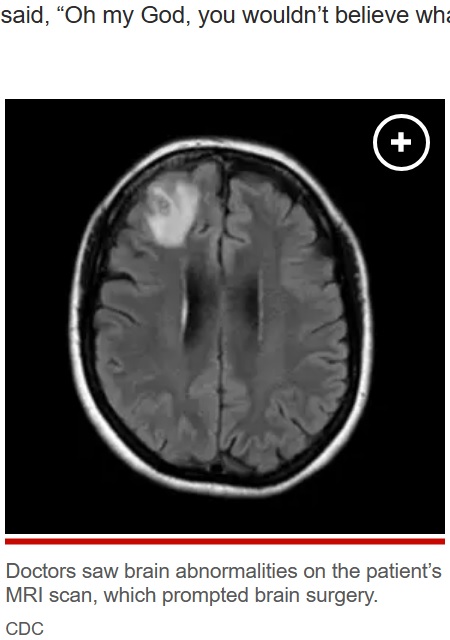 数年前から体調不良を訴え、通院していた64歳女性。うつ病などの症状が加わり精密検査を行ったところ、脳の手術が必要なことが判明した（画像は『New York Post　2023年8月28日付「Worm discovered living in woman’s brain in world’s first case: ‘It’s alive!’」（CDC）』のスクリーンショット）