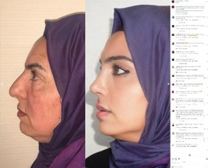 ディレクさんと同じ鼻形成術、眼瞼形成術、フェイスリフト、ネックリフトをした場合、費用は通常約1万～1万6000ドル（約147万～236万円）かかるという（画像は『Dr. MAY Facial Plastic Surgery　2023年9月11日付Instagram「Our lovely patient Miss Dilek after 2 years of rhinoplasty face lift and blepheroplasty surgeries..」』のスクリーンショット）