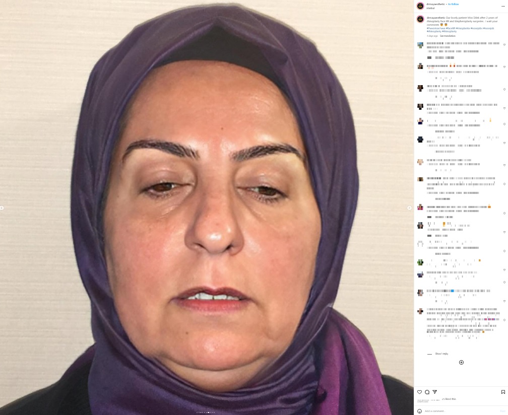 トルコ、イスタンブールの「ドクター・メイ・フェイシャル形成外科（Dr. MAY Facial Plastic Surgery）」で美容整形を受ける前の68歳の女性。Instagramにビフォーアフターが投稿されて注目された（画像は『Dr. MAY Facial Plastic Surgery　2023年9月11日付Instagrtam「Our lovely patient Miss Dilek after 2 years of rhinoplasty face lift and blepheroplasty surgeries..」』のスクリーンショット）