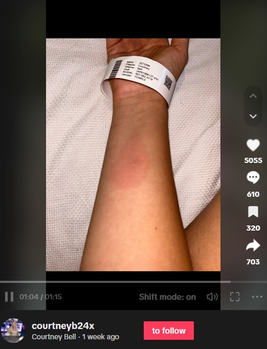 パッチテストをして皮膚が赤くなったにもかかわらず、サロンの施術者は「アレルギーではない」と言って施術を開始した。しかし病院の医師には「施術をするべきではなかった」と言われたという（画像は『Courtney Bell　2023年9月13日付TikTok』のスクリーンショット）