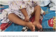 【海外発！Breaking News】牛用の注射針を8本飲み込んだ2歳男児、奇跡的に助かる（ペルー）