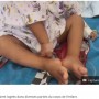 【海外発！Breaking News】牛用の注射針を8本飲み込んだ2歳男児、奇跡的に助かる（ペルー）