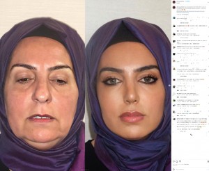 トルコの形成外科が今年9月、68歳女性の美容整形のビフォーアフター写真をSNSに投稿。「フェイクでは？」と大炎上していた（画像は『Dr. MAY Facial Plastic Surgery　2023年9月11日付Instagram「Our lovely patient Miss Dilek after 2 years of rhinoplasty face lift and blepheroplasty surgeries..」』のスクリーンショット）