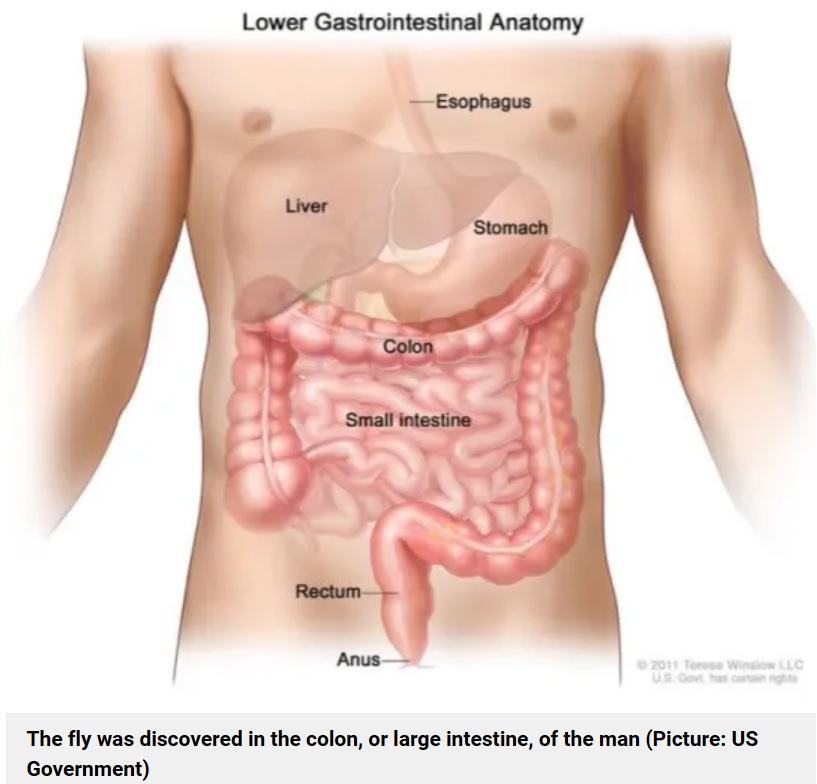 大腸カメラ検査を受けていた63歳男性の横行結腸から、ほぼ無傷で体がキレイに残った状態のハエが見つかった。珍しい発見に、担当医は驚いたという（画像は『Metro　2023年11月22日付「Mystery after doctors find live fly buzzing around inside man’s intestines」（Picture: US Government）』のスクリーンショット）