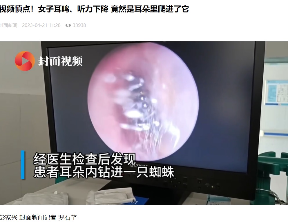 中国四川省の病院を今年4月に受診した女性。耳鳴りを訴えたが、その耳の中にはクモが糸を張っていた（画像は『封面新闻　2023年4月21日付「视频慎点！女子耳鸣、听力下降 竟然是耳朵里爬进了它」』のスクリーンショット）