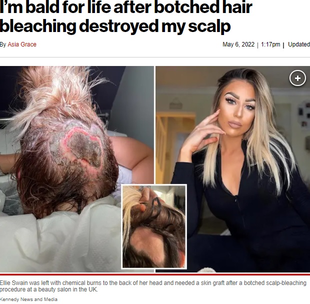 英ロンドン在住の女性は2021年5月、美容院でブリーチしたところ後頭部に化学熱傷を負ってしまった（画像は『New York Post　2022年5月6日付「I’m bald for life after botched hair bleaching destroyed my scalp」（Kennedy News and Media）』のスクリーンショット）