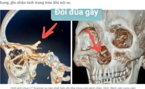 鼻の奥から頭蓋骨に達した2本の箸。男性は約5か月前、酒を飲んでいてけんかになり緊急治療室で手当てを受けていたが、鼻の異常は指摘されなかったという（画像は『Báo Nhân Dân điện tử　2023年11月28日付「Cứu 1 người bị đũa đâm xuyên từ mũi lên não」（Ảnh Bệnh viện cung cấp）』のスクリーンショット）