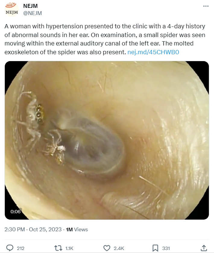 今年10月、医学雑誌に掲載された症例では、台湾在住の女性の耳から生きたクモが見つかった。クモは耳の中で脱皮をしており、その抜け殻も確認できたという（画像は『NEJM　2023年10月25日付X「A woman with hypertension presented to the clinic with a 4-day history of abnormal sounds in her ear.」』のスクリーンショット）