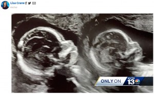 2つの子宮をもつケルシーさん。それぞれの子宮に妊娠したことを医師に告げられ、夫ケイレブさんも驚いたという（画像は『WVTM 13　2023年11月10日付「Dora mom with double uterus pregnant in both」』のスクリーンショット）