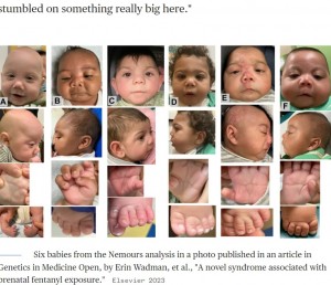 妊娠中にフェンタニルを使用した母親から生まれた赤ちゃん全員に小頭症、低身長、特徴的な顔貌が見られた。また複数に口蓋裂、足の変形（丸みを帯びた揺り椅子状足底）、生殖器の奇形、短く幅が広い親指、合趾症などが確認できた（画像は『NBC News　2023年12月5日付「New syndrome in newborns exposed to fentanyl possibly found」（Elsevier 2023）』のスクリーンショット）