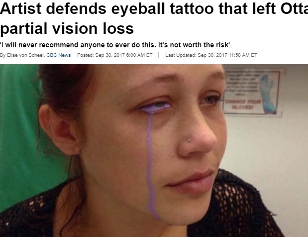 カナダ在住の女性は2017年、付き合い始めたばかりのタトゥーアーティストに目のタトゥーを施術してもらった。しかし施術後に右目からインクが流れ出し、失明の危機に陥ってしまったという（画像は『CBS News　2017年9月30日付「Artist defends eyeball tattoo that left Ottawa woman with partial vision loss」（Catt Gallinger / Supplied）』のスクリーンショット）