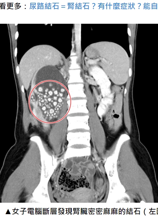高熱と右腰部の痛みを訴え、台南の救急外来を訪れた20歳女性の腎臓。水をほとんど飲まなかったそうで、多数の結石ができていた（画像は『健康2.0　2023年12月8日付「她手搖飲取代白開水，喝出300多顆腎結石！」（奇美醫院提供）』のスクリーンショット）