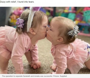 米ミシガン大学C.S.モット小児病院で2019年6月11日に誕生した結合双生児。2020年8月に分離手術を受け、母親は「2人は距離を置き、それぞれに楽しみを見つけています」と語っていた（画像は『news.com.au　2022年5月31日付「‘Your little sisters are stuck together’: Conjoined twins’ risky separation surgery」（Picture: Supplied）』のスクリーンショット）
