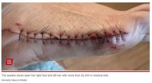 足に14針縫う大怪我をしたリアンさん（『New York Post　「Temu customer’s foot sliced open by ‘razor sharp’ stud found in new ＄12 boots, left to pay thousands in medical bills」（Kennedy News ＆ Media）』より）