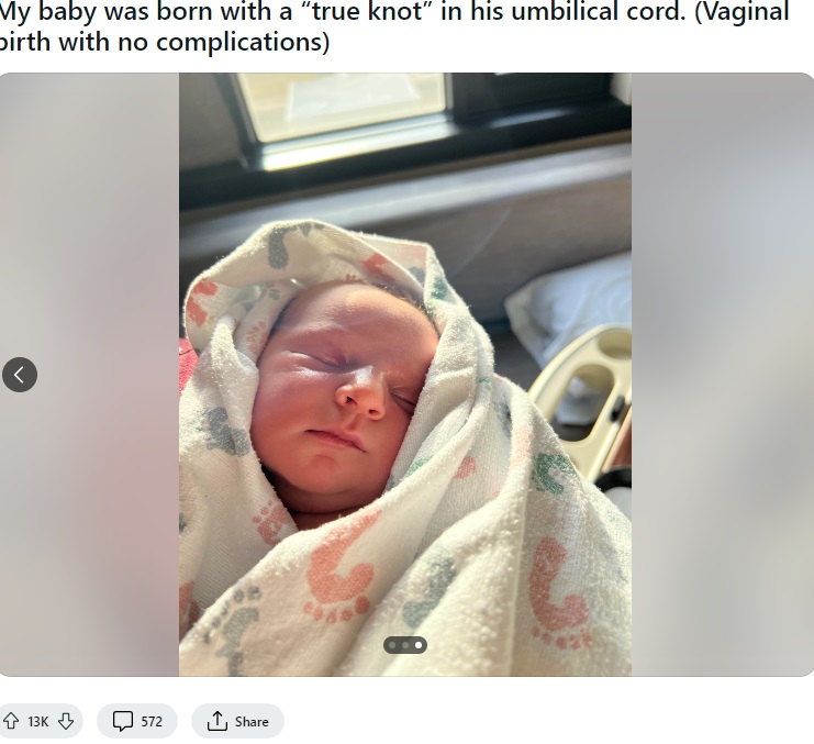 へその緒（臍帯）に完全な結び目ができた状態で誕生した男の子。写真は『Reddit』に今月9日、父親によって投稿されたもの（『-coolcoolcool-　Reddit「My baby was born with a “true knot” in his umbilical cord. （Vaginal birth with no complications）」』より）