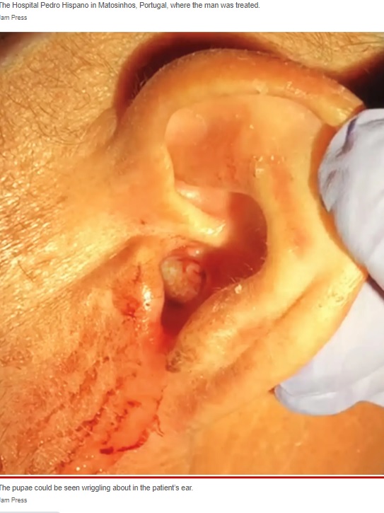 ポルトガルの病院に駆け込んだ64歳男性の症例が2022年11月、医学雑誌に掲載される。男性の耳の中からは、ハエの幼虫であるウジが摘出されていた（『New York Post　「My earache was actually a potentially fatal, revolting infestation」（Jam Press）』より）