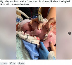 ニックさんは医師に「へその緒がへそにこれほど近い位置で結ばれているのを見たのは初めて」と言われたという。またへその緒は、男児の肩や両脚にも巻き付いていたそうだ（『-coolcoolcool-　Reddit「My baby was born with a “true knot” in his umbilical cord. （Vaginal birth with no complications）」』より）