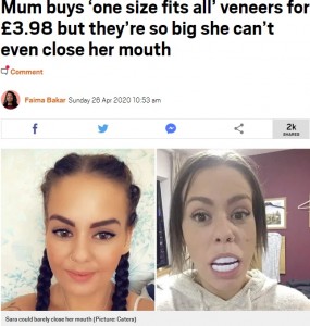 2020年、イギリス在住の30歳女性が約500円で人工歯（ベニア）をネット購入。それを装着したところ、「大きすぎて口が閉まらない」結果に（『Metro　「Mum buys ‘one size fits all’ veneers for ￡3.98 but they’re so big she can’t even close her mouth」（Picture: Caters）』より）