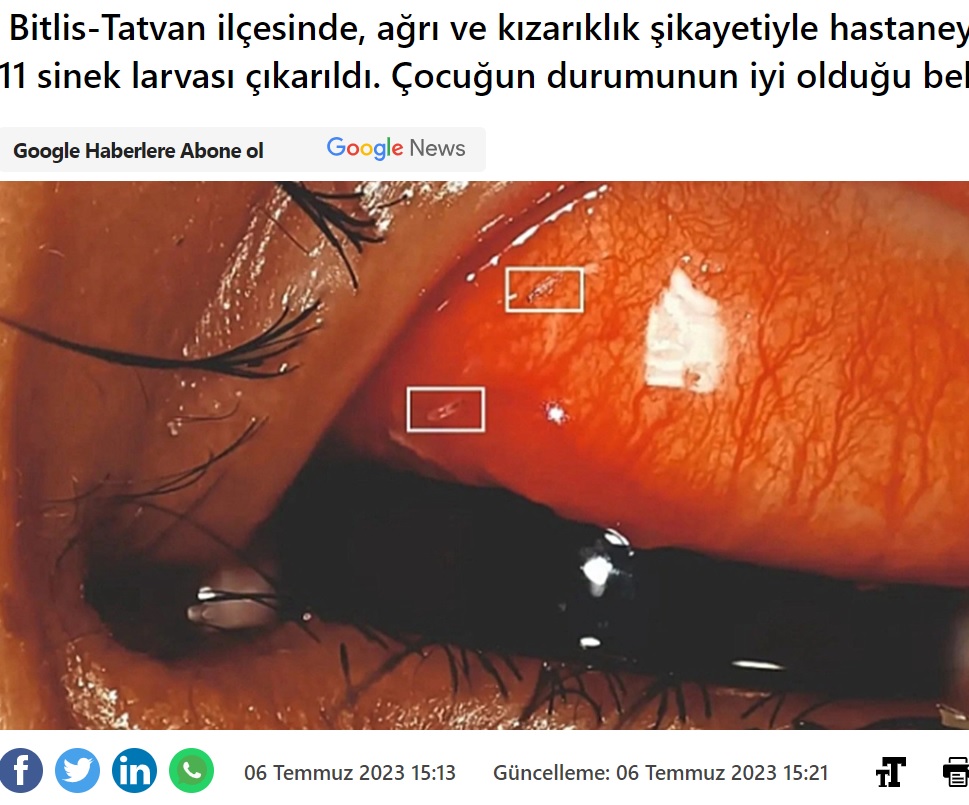 トルコの病院で2023年7月、10歳男児の左瞼の裏から11匹のハエの幼虫（ウジ）が摘出された。医師によると、瞼の裏で幼虫が動き回っていたという（『MedyaTava　「10 yaşındaki çocuğun gözünden ne çıktı7」』より）
