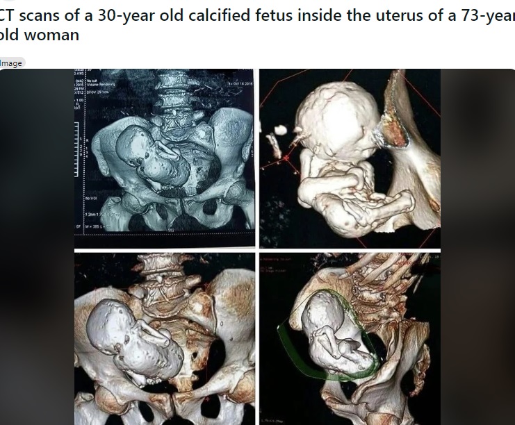 2021年にアルジェリアの73歳の女性から見つかった石児。妊娠7か月まで成長し、体重は2040グラム超（4.5ポンド）で、女性の腹部に35年間も留まっていたという（『r/Damnthatsinteresting　Reddit「CT scans of a 30-year old calcified fetus inside the uterus of a 73-year old woman」』より）