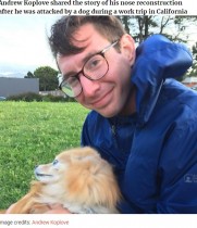 【海外発！Breaking News】犬に襲われ鼻のほとんどを失った37歳男性、再建手術14回で見事な変身「人生を取り戻した」（米）
