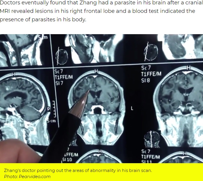 2019年7月、中国広東省在住の59歳の男性の脳から約10センチの寄生虫が摘出された。男性は30年にわたり、片頭痛やめまいに悩まされていたという（『AsiaOne　「Worm lived in Chinese man’s brain for 30 years, causing headaches and seizures」（PHOTO:Pearvideo）』より）
