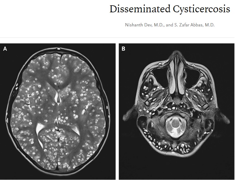 医学雑誌『ニューイングランド・ジャーナル・オブ・メディシン』で2019年3月、インドの18歳少年が神経嚢虫症により死亡したケースが報告される。少年の大脳皮質（右）と脳幹・小脳には多数の嚢胞が見られた（『The New England Journal of Medicine　「Disseminated Cysticercosis」』より）