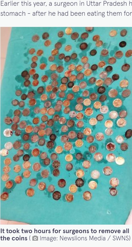インド南西部カルナータカ州の病院で2022年11月、58歳男性の胃から187枚の硬貨が摘出されていた（『The Mirror　「Doctors discover 187 coins in man’s stomach after he complained he was ‘bloated’」（Image: Newslions Media / SWNS）』より）