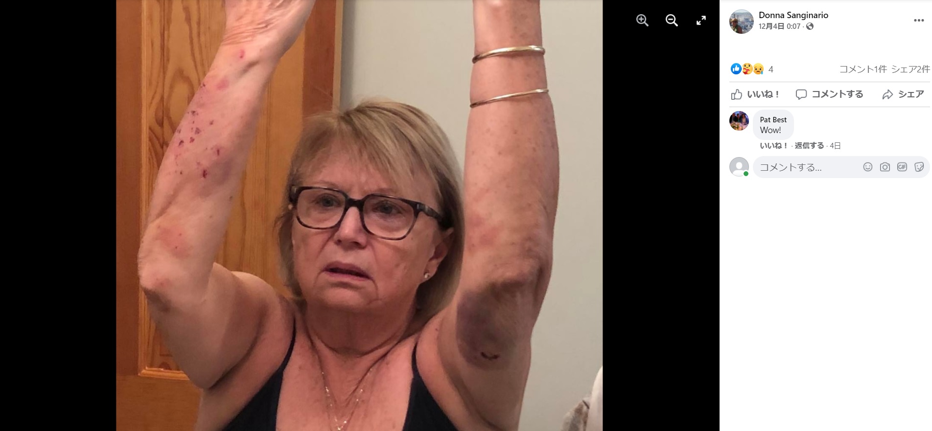 米マサチューセッツ州在住の70歳女性は2021年12月、庭の植木にイルミネーションを飾り付けていたところ突然、野生のアライグマに襲われた。女性は噛まれながらもヘッドロックで対抗したという（『Donna Sanginario　Facebook「This past Wednesday around 4 pm.」』より）