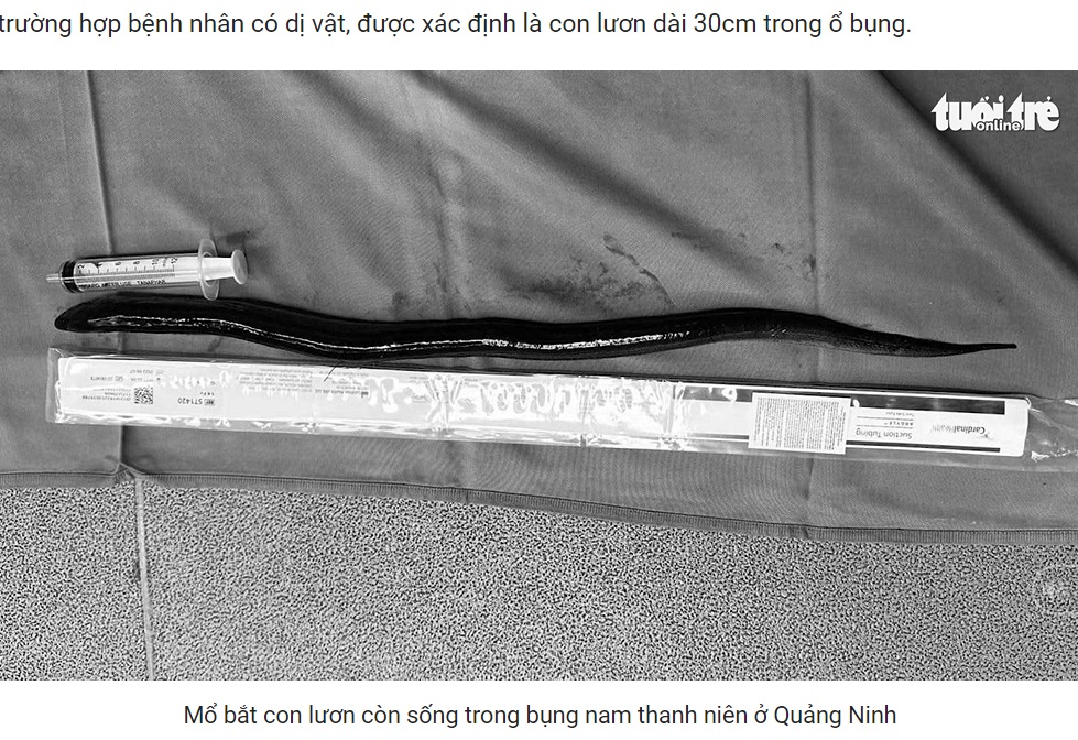 検査の結果、消化管内に異物があることや、男性の腸に穴が開き腹膜炎を起こしていることが判明。手術で体長30センチのウナギが摘出された（『Báo Tuổi Trẻ　「Hy hữu: Phát hiện con lươn dài 30cm trong ổ bụng, gây thủng ruột nam thanh niên」』より）