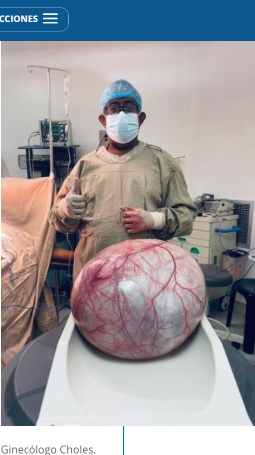 コロンビアで2023年7月、31歳女性の腹部から摘出された約12キロの腫瘍。患者は「妊娠した」と思っていたそうだ（『El Tiempo　「Extraen un tumor de 12 kilos a una mujer en el municipio de Uribia, La Guajira」（FOTO: Portal La Guajira Hoy）』より）