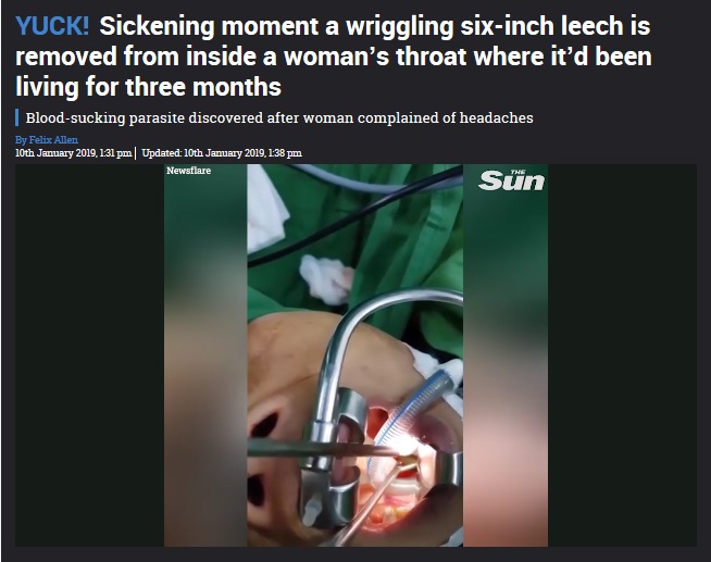 ベトナムのハザン省在住の63歳女性患者から2019年、15センチのヒル摘出された。女性は3か月間、深刻な片頭痛に悩まされていたという（『The Sun　「YUCK! Sickening moment a wriggling six-inch leech is removed from inside a woman’s throat where it’d been living for three months」（Newsflare）』より）