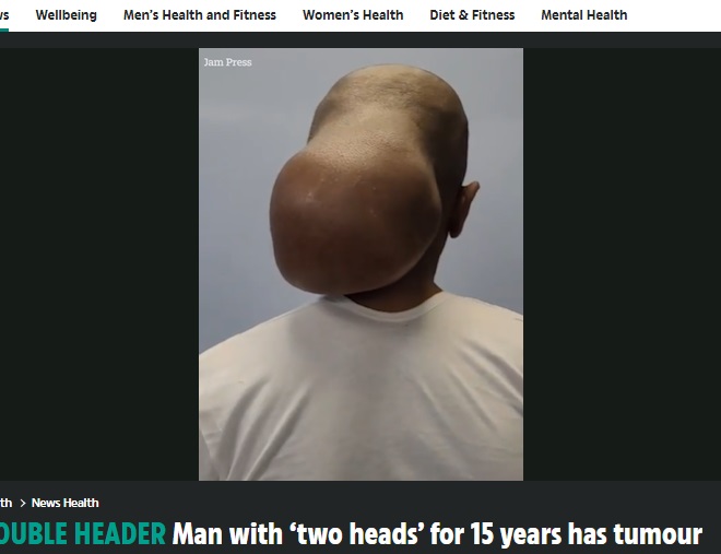 後頭部にもう一つの頭がぶらさがっているような状態で病院を訪れた男性。腫瘍は15年をかけて少しずつ大きくなったという（『The Sun　「DOUBLE HEADER Man with ‘two heads’ for 15 years has tumour size of a melon removed after it ‘damaged his skull’」（Credit: Jam Press/Rare Shot News）』より）