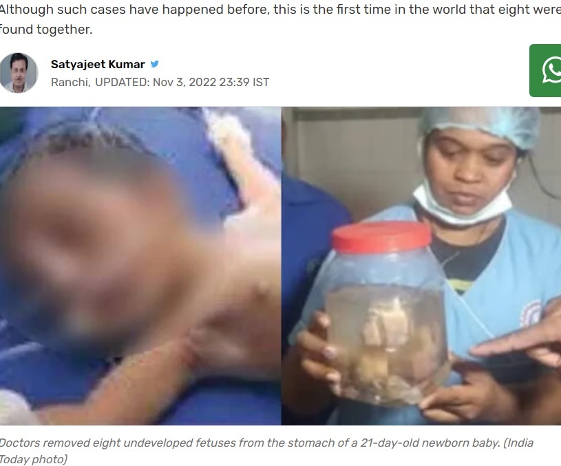 インドの小児病院で2022年、生後20日を過ぎた女児（左）の腹部から不完全な胎児8体が摘出された。女児は誕生後、腹部が異様に腫れてしこりがあったという（『India Today　「8 undeveloped fetuses found inside stomach of newborn baby」（India Today photo）』より）