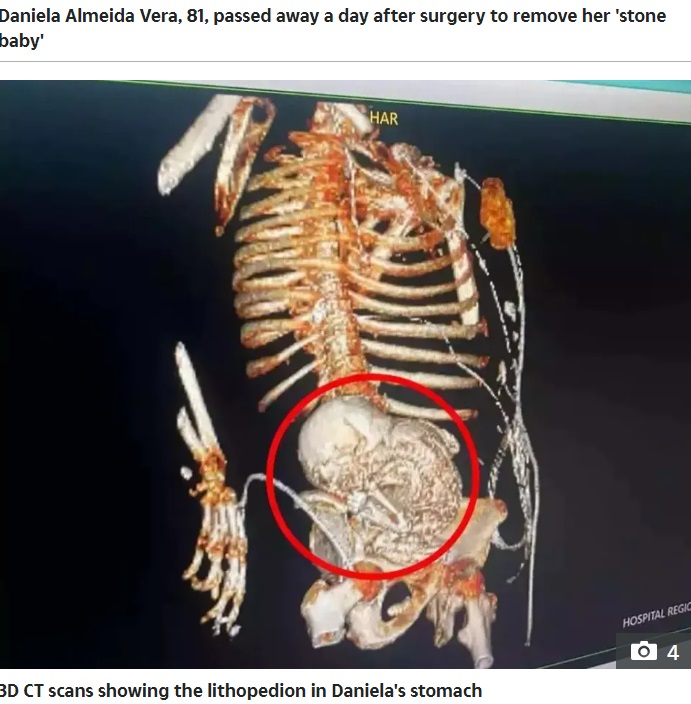 ブラジルに住む81歳の女性の腹部に石灰化した胎児が見つかり、今年3月14日に摘出手術を受けるも翌日に死亡した。医師はこの胎児について、少なくとも56年間、腹部に留まっていたのではないかと推測していた（『The Sun　「BABY OP TRAGEDY ‘Pregnant’ OAP, 81, dies after surgery to remove ultra-rare ‘stone baby’ she’d been carrying for more than 50 years」』より）