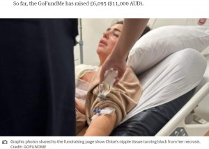 英ウェスト・ヨークシャー在住の女性は今年1月、トルコで乳房リフト手術を受けた。女性は術後、激痛に悶え苦しみ、乳首が壊死してしまったという（『PerthNow　「Chloe Rose: UK mum’s boob job in Turkey goes terribly wrong, develops necrosis from dying nipple tissue」（Credit: GOFUNDME）』より）