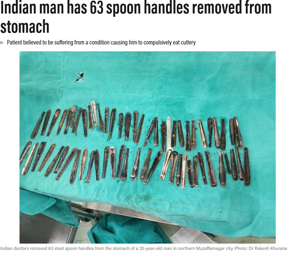 印ウッタル・プラデーシュ州の病院で2022年9月、32歳の男性の胃から63本のスプーンを摘出。医師は男性について異食症の可能性を指摘していた（『The National　「Indian man has 63 spoon handles removed from stomach」（Photo: Dr Rakesh Khurana）』より）