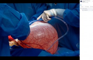 エクアドルの病院で2023年10月、43歳の女性の腹部から重さ13キロの卵巣腫瘍が摘出された。女性は体重増加に悩んでいたという（『Hospital General Monte Sinaí Guayaquil　Facebook「＃BolletínDePrensa」』より）