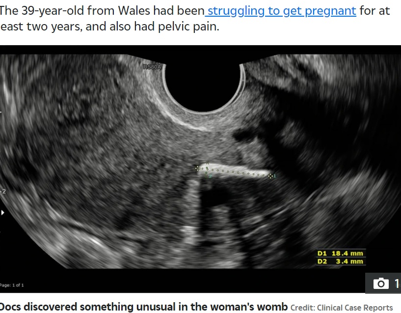 2022年、英ウェールズに住む39歳の女性の子宮から20年前に中絶した胎児の骨片が見つかった。女性は数年間子供ができず、慢性的な骨盤の痛みに苦しんでいたという（『The Sun　「MAMMA MIA Doctors discover staggering reason woman couldn’t get pregnant after abortion 20 years ago」（Credit: Clinical Case Reports）』より）